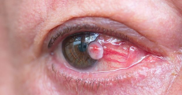 Pterjium (Göz Eti Büyümesi) Ameliyatı Aşamaları ve İyileşme Süreci