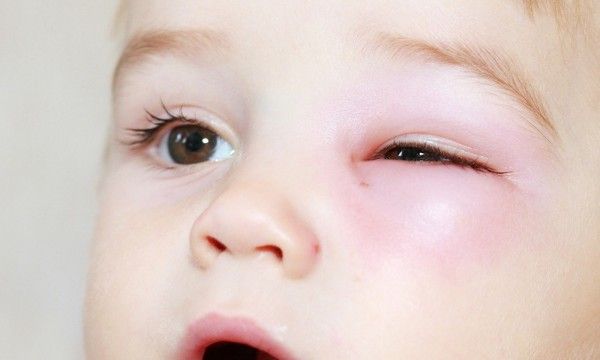 alerjik göz şişmesi nasıl anlaşılır