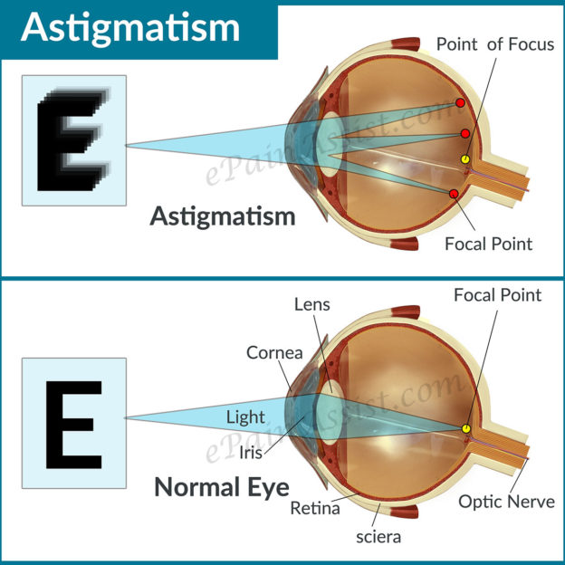 astigmat-belirtileri-hastal-n-lerleme-a-amalar-ve-sonu-lar