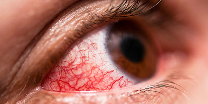 göz iltihabı iyileşme süreci nasıl hızlandırılır