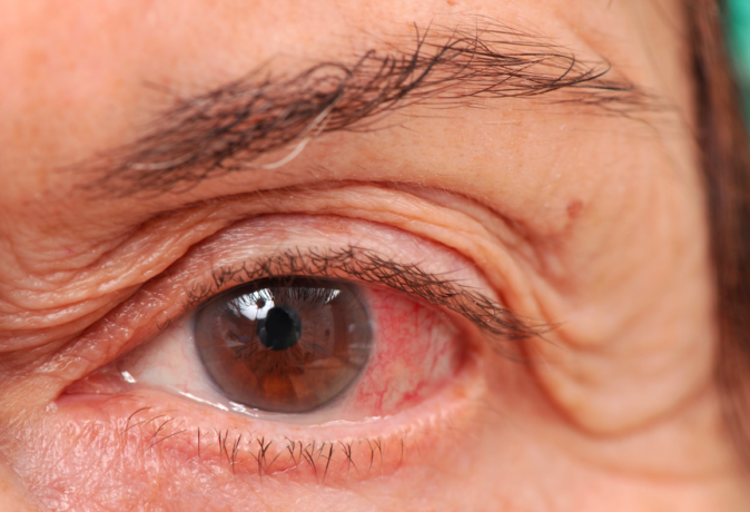 göz tansiyonu bitkisel tedavi