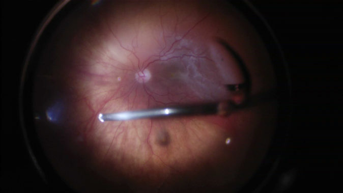retina ameliyatı